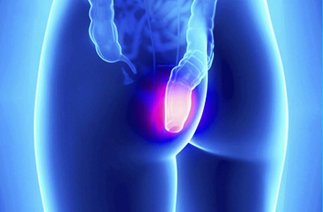 Gelarex peut être utilisé à la fois par voie externe et rectale